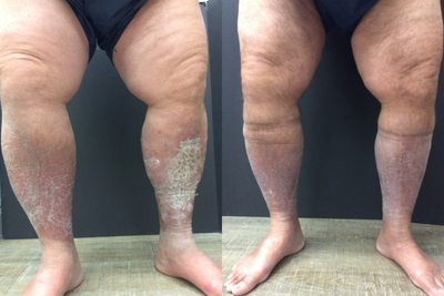 55-64 year old man treated with Vein Treatment - Before and after vein treatment