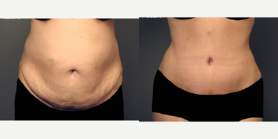 35-44 year old woman treated with Panniculectomy - Post Gastric Bypass and Weight Loss