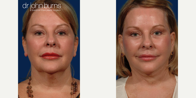 Woman treated with SMAS Facelift - Woman treated with SMAS Facelift as well as Facelift, Neck Lift with corset platysmaplasty, Lower Face/Neck Liposuction, and Buccal Fat Removal.