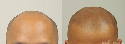 18-24 year old man treated with Hair Loss Treatment - Scalp MicroPigmentation SMP