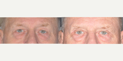 65-74 year old man treated with Double Eyelid Surgery - Bilateral upper eyelid blepharoplasty