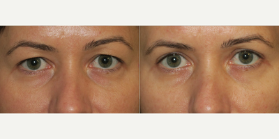 Woman treated with Eyelid Surgery - Woman treated with Eyelid Surgery
