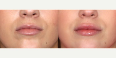 27 year old woman treated with Lip Fillers, Juvederm - 27 year old female treated with 1 syringe of Juvederm Ultra XC to lips. Photos depict before and 1 month after treatment.