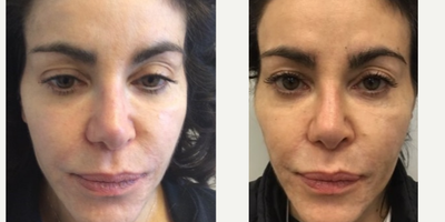 55-64 year old woman treated with Silhouette InstaLift  Contour Thread Lift - Silhouette InstaLift Suture Lift. Results after 2 weeks.