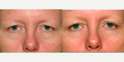 Woman treated with Thermage - Thermage