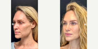 Woman treated with Deep Plane Facelift, Facelift, Neck Lift - She was gorgeous before and all we did was my DEFINE LIFT. A Deeplane Extended Facelift Including Necklift and the Elevation of the brows, as well as a touch of fat transfer. You can see she looks like herself just rejuvenated. My goal with facelift rejuvenation is always to try to make the patient a little more prettier or handsome. It's never meant to change the way they look.