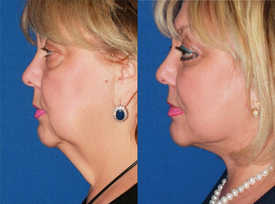 55-64 year old woman treated with Facelift - This patient presented with advanced signs of facial aging. There is extensive skin laxity in the neck, significant jowls, sagging cheeks and bags under the eyes. All of these changes makes the patient look somewhat older than her stated age. Facial rejuvenation procedure included deep plane facelift, platysmaplasty, and lower blepharoplasty. Significant facial rejuvenation was achieved by tightening up excessive skin of the neck, smoothing out prominent jowls and restoring a pleasing cheek contour and eyelid shape.