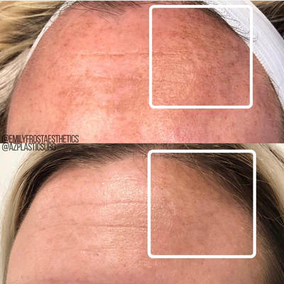 35-44 year old woman treated with Vivace - Vivace