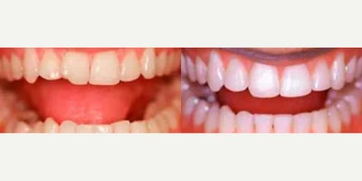 Woman treated with Teeth Whitening - Woman treated with Teeth Whitening