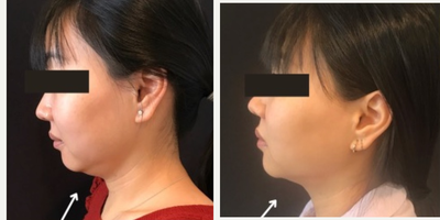 25-34 year old woman treated with Kybella - kybella chin treatment by Dr. Deborah Marciano