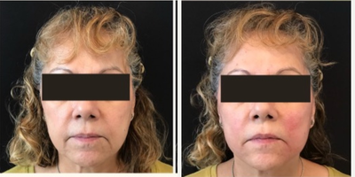 45-54 year old woman treated with Thread Lift - Thread lift treatment mid-face by Dr. Deborah Marciano