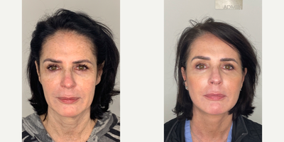55-64 year old woman treated with Facelift, Neck Lift, Eyelid Surgery, Facial Fat Transfer, CO2 Laser - 58 year old patient 3 months after Facelift, Neck lift, Upper Eyelid Blepharoplasty, Fat Transfer and CO2 laser.
