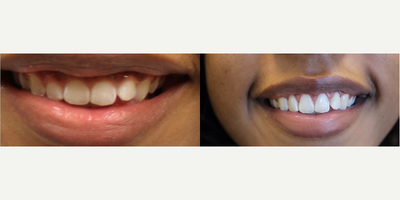 Woman treated with Gum Lift - Woman treated with Gum Lift.