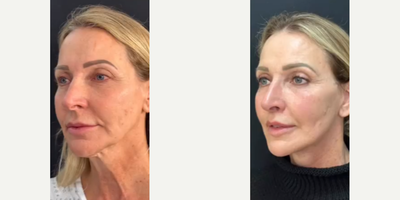 Woman treated with Neck Lift - Woman treated with Deep Plane Facelift,Temporal Brow Lift, Lip Lift, and Facial Fat Transfer, shown 3 months post op.
