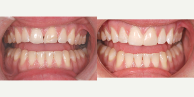 25-34 year old man treated with Dental Bonding - 1 hours visit, no injections, direct composite.&nbsp;
