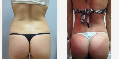 18-24 year old woman treated with Smart Lipo - Smart Lipo to waist and fat transfer to butt. We don't like to go overboard. Our BBL's (Brazillian Butt Lifts) are very subtle.