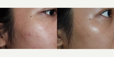DPN mole removal Los Angeles, dermatosis papulosa nigra. - If you have Asian or African American skin, it's possible you may get DPN moles as you get older.  These are really easy to get rid of in one visit with minimal downtime.