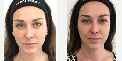 Skin Tightening using Profhilo - Profhilo Treatment