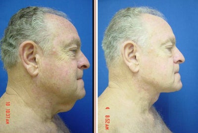 67 Year Old Male Treated for Skin Laxity of the Neck - 
	67 Year Old Male Diagnosis: Skin Laxity of the Neck Procedure: Necklift
