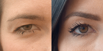 Non Surgical Eyelid Lift using Botox - With age, the line of the eyebrows becomes lower and the skin around the eyes becomes saggy, which can give a tired and sad look. This phenomenon can also be observed in younger patients. This condition can be effectively treated with neuromodulators.