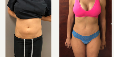 45-54 year old woman treated with Emsculpt - Results after standard four series of Emsculpt treatments in our office.