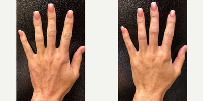 25-34 year old woman treated with Restylane Lyft - Restylane Lyft  for hand rejuvenation