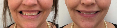 35-44 year old man treated with Botox for Gummy Smile - Used to relax the upper lip for gummy smiles.