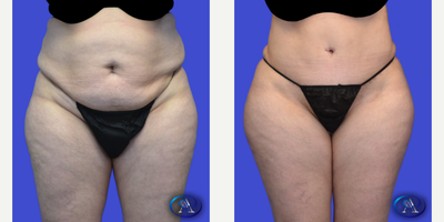 45-54 year old woman treated with Tummy Tuck, Umbilical Hernia Repair, Liposuction - 46-year-old patient 6 months post abdominoplasty, hernia repair + liposuction to flanks