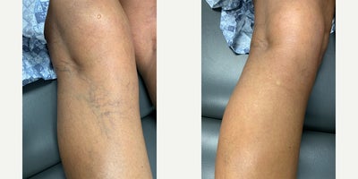 35-44 year old woman treated with Asclera - sclerotherapy for spider veins with Radhika, the Nurse Practitioner at Wise med spa
