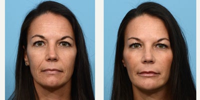 45-54 year old woman treated with Lower Facelift - nasolabial folds, lip lining, lip filler, cheeks, chin and jawline, forehead/11s/crows feet botox; botox brow lift