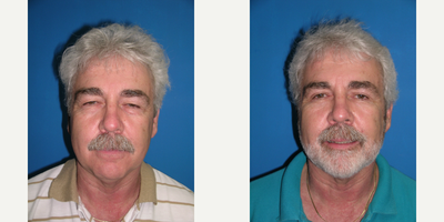 60 year old man with upper and lower blepharoplasties and fat grafting. - Before and 2 months after upper and lower blepharoplasties. On the upper lids skin and fat was removed. On the lower fat was removed and fat grafting was done to fill the sulcus under the lower eyelids.