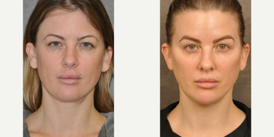 Minilift/ Neck Lift - MiniLift / Neck Lift with cheek fillers and dysport  Front - This young, beautiful patient had suffered some complications from liposuction causing neck irregularities. A mini lift / neck lift was performed under local anesthesia to help lift and contour the lower face jawline and neck. Fillers were placed under the eye and around the cheek to give a more youthful and contoured cheek appearance. Dysport was used to gently lift the eyebrows.