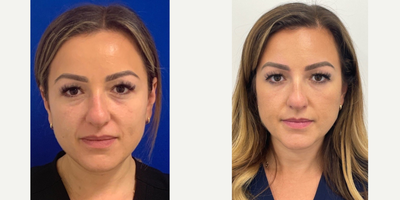 25-34 year old woman treated with Belotero - Belotero to fill in under eye hollows.
