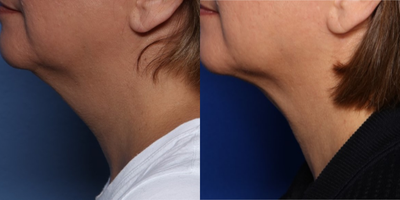 45-54 year old woman treated with FaceTite - 54 year old female shown 9 months after undergoing FaceTite combined with Morpheus8 RF microneedling to her neck and lower face.