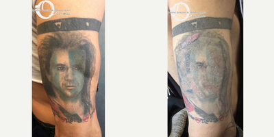 25-34 year old man treated with Tattoo Removal - after 1 session tattoo removal