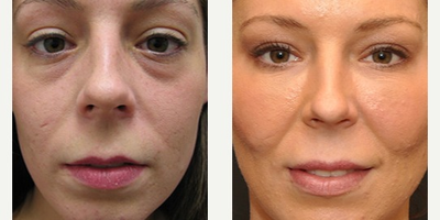 Woman treated with Botox - Injectable Fillers