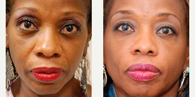 Woman treated with Botox - Injectable Fillers