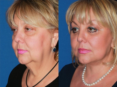55-64 year old woman treated with Facelift - This patient presented with advanced signs of facial aging. There is extensive skin laxity in the neck, significant jowls, sagging cheeks and bags under the eyes. All of these changes makes the patient look somewhat older than her stated age. Facial rejuvenation procedure included deep plane facelift, platysmaplasty, and lower blepharoplasty. Significant facial rejuvenation was achieved by tightening up excessive skin of the neck, smoothing out prominent jowls and restoring a pleasing cheek contour and eyelid shape.
