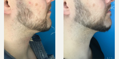 25-34 year old man treated with Aqualyx - Just 1 session of Aqualyx.