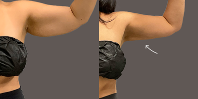 25-34 year old woman treated with AirSculpt - Female patient received arm airsculpt in our San Diego location