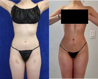 Woman treated with Brazilian Butt Lift - Woman treated with Brazilian Butt Lift