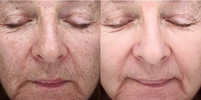 Woman treated with Obagi Nu-Derm - These amazing results are from a combination of Obagi Nu-Derm and only one forever young BBL!