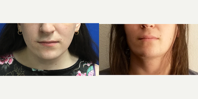 Patient treated with Facial Fat Transfer, Genioplasty, Lip Lift, Lip Surgery - Chin Reduction and Contour, Subnasal Lip Lift wit - 25 to 34 year-old female patient is 1 year 7 months post-op from Facial Feminization surgery. Her procedures included: Placement of Tissue Expander with Hairline Forehead Lift and Orbital Bony Contouring, Septorhinoplasty (closed) with Cartilage Grafts and Weirs, Cheek Implants (small), Chin Reduction and Contour, Subnasal Lip Lift with Fat Augmentation to Lips, Thyroid Cartilage Shave, Submental Liposuction, Removal of Tissue Expander and Left Mayer Flap.