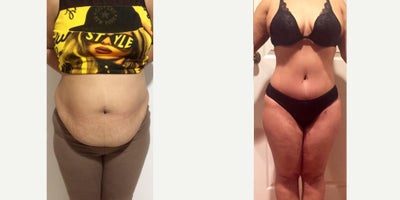 Tummy Tuck + Intense Lipo + Dominican Butt Lift (Dbl) - Tummy Tuck + 10 liters (10,000cc) fat removed from tummy, waist, flanks, armpits, upper/lower back, inner thighs and chin liped areas + DBL of 3,000cc fat transferred to butt and hips.
