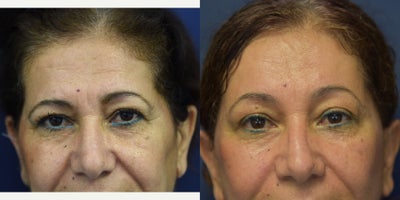 55-64 year old woman treated with Brow Lift - Patient complained of a heavy set brow. She was treated with an endoscopic brow-lift.