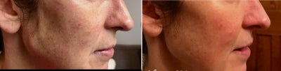 45-54 year old woman treated with Injectable Fillers - Injectable HA dermal filler using Profhilo for skin and texture rejuvenation with some lift and subtle natural anti ageing affect. Skin is tighter, less fragile, smoother, more hydrated, better quality. Patient can't stop smiling.