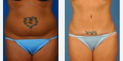 35-44 year old woman treated with Tummy Tuck - Post pregnancy concerns with excess skin and fatty tissue. Goal of being able to wear a bikini