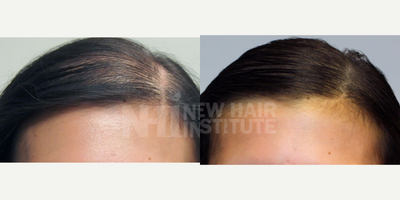18-24 year old woman treated with Scalp Micropigmentation - 18-24 year old woman treated with Scalp Micropigmentation