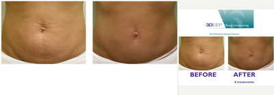 3DEEP EndyMed Skin Tightening - 3DEEP EndyMed RF Skin Tightening treatment was done to treat abdominal skin laxity after twin delivery. Total once a week, six treatments were done. Painless, quick and no down time procedure. No after care required.