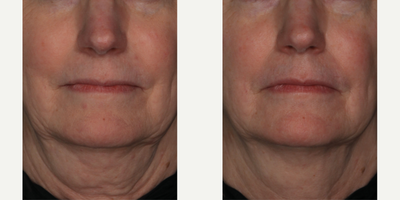 Skinbetter Science - InterFuse Intensive Treatment Cream Face & Neck.Photo provided courtesy of Skinbetter Science.